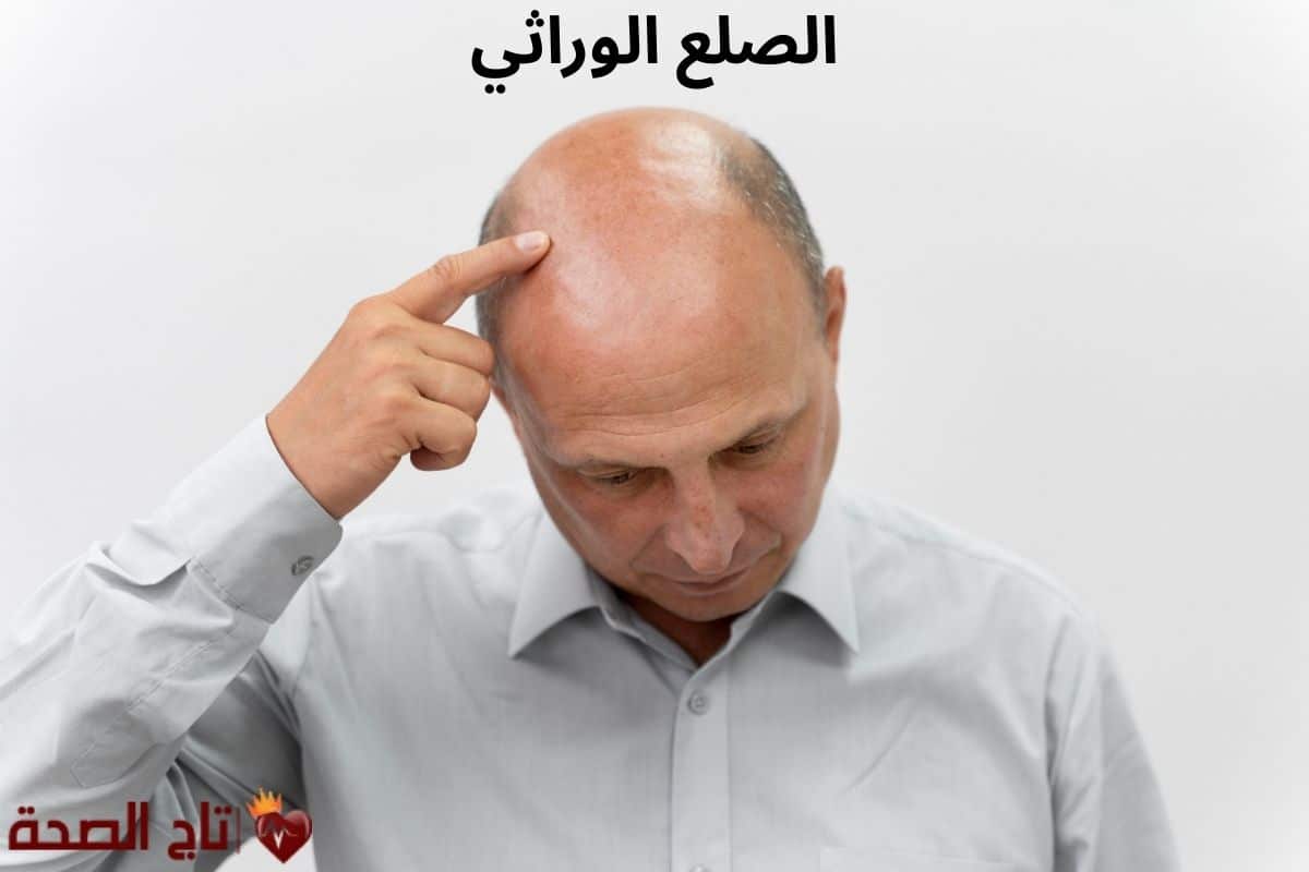 الصلع الوراثي: أسبابه وأعراضه وطرق العلاج الحديثة لاستعادة ثقتك