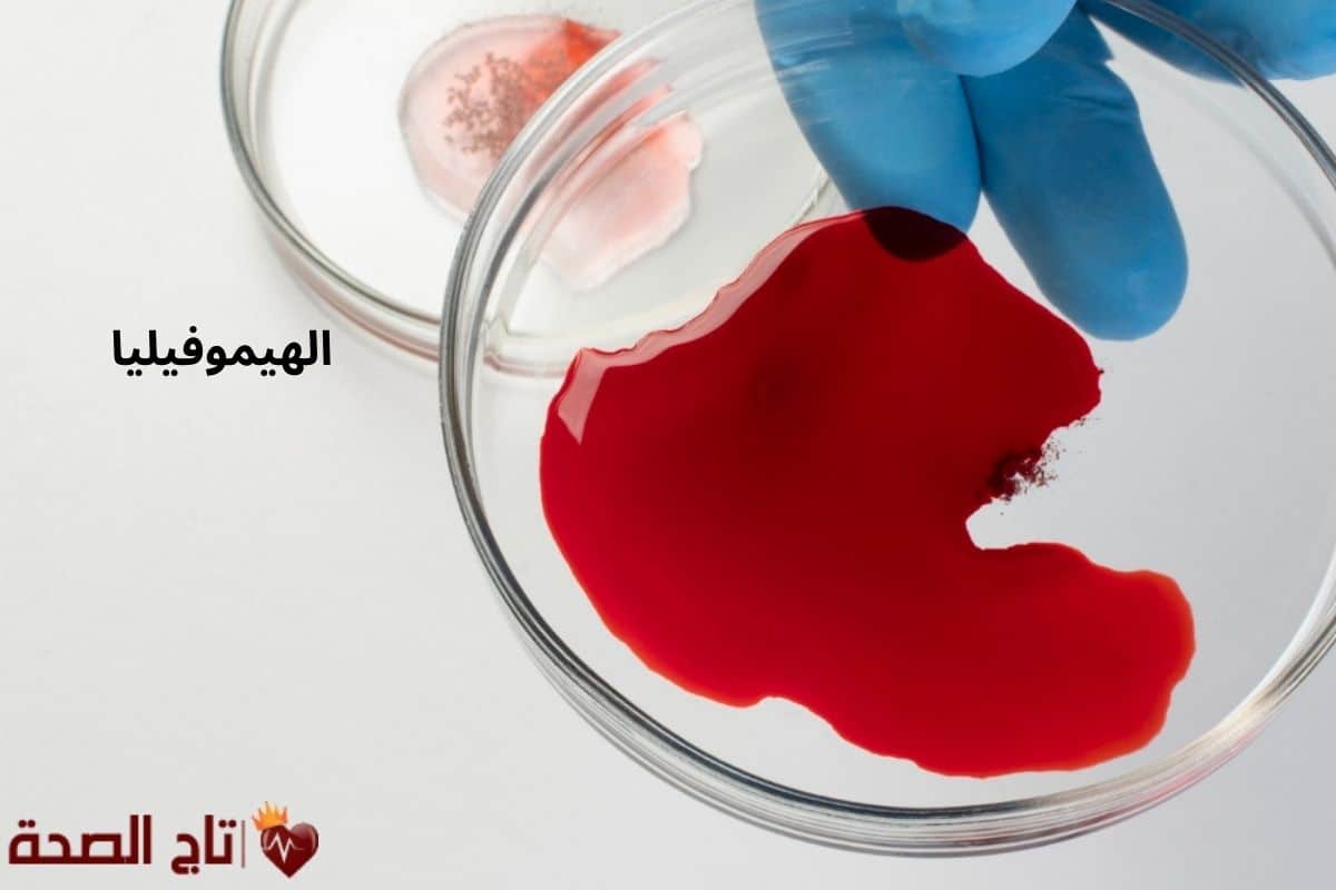 فقر الدم