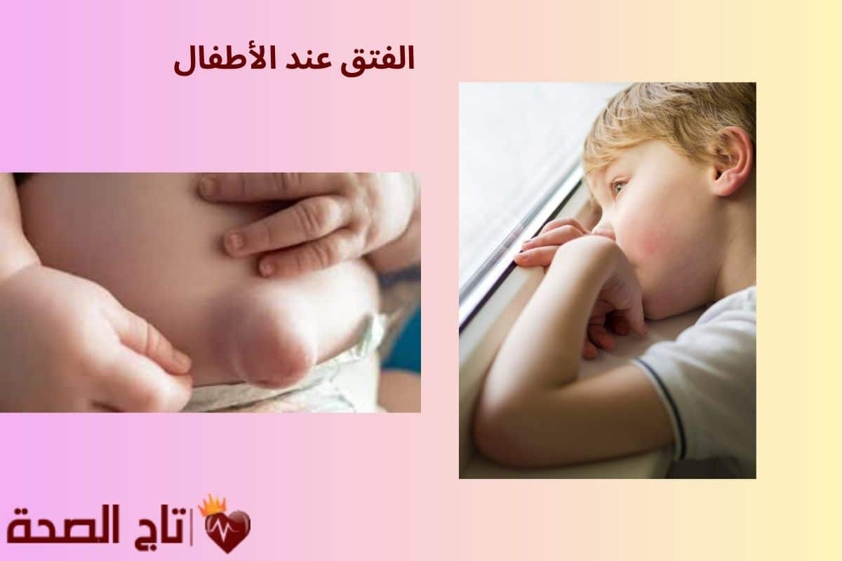 5 علامات تدل على وجود الفتق عند الأطفال