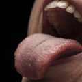 اسباب فطريات الفم المتكررة
