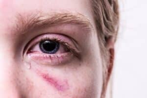 علاج انتفاخ العين | أفضل 8 طرق لعلاج انتفاخ عينيك